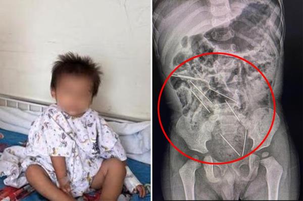 医生从2岁男孩的胃里取出8根针