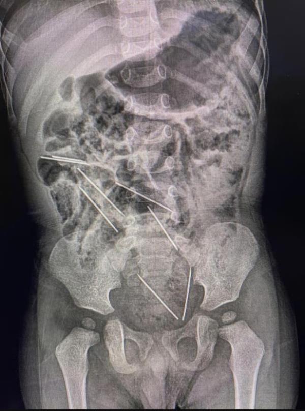 The X-ray revealed eight needles in the boy's abdomen. 