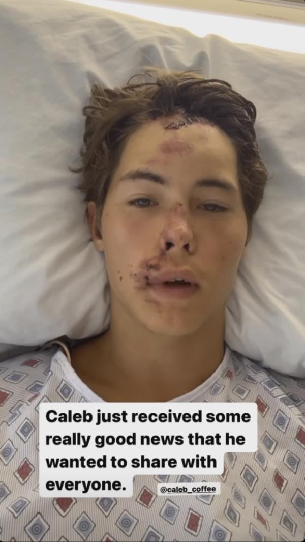 Doctors initially believed Coffee suffered multiple serious injuries, including a spinal fracture, broken neck, broken femur and burns all over his body. 