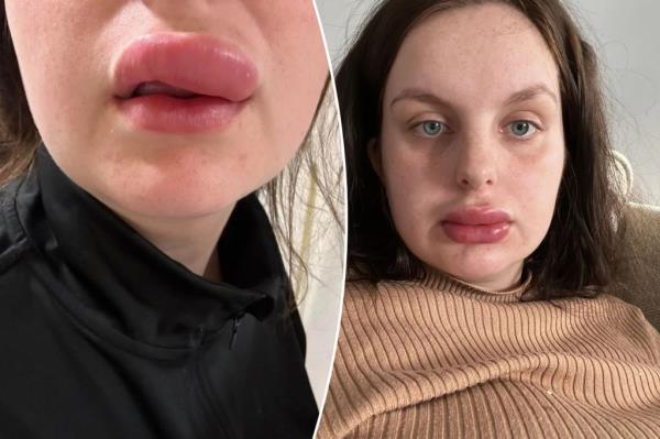Ellie Gallear, 22, was thrilled when she won a $12 raffle Facebook for a lip filler treatment -- but, instead, she was met with a horrible allergic reaction and botched lips.