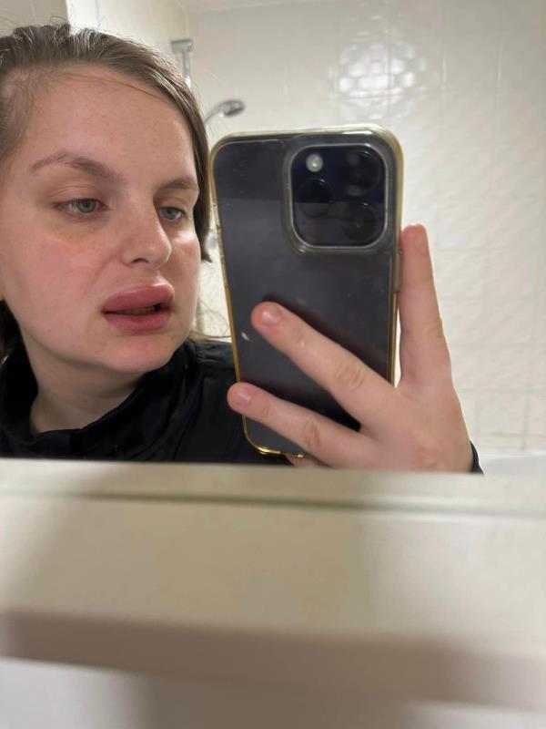 Photo of someone with swollen lips taking a selfie in a mirror with an iPhone. 
