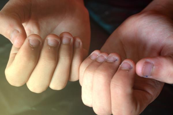Person showing both hands with bitten nails.
