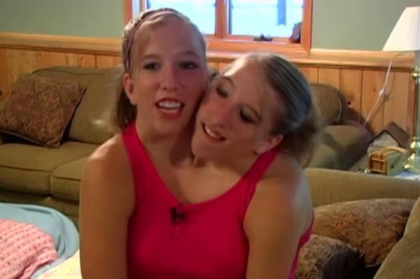 Both Abby and Brittany — who were born as dicephalous co<em></em>njoined twins — starred in their own short-lived TLC show 