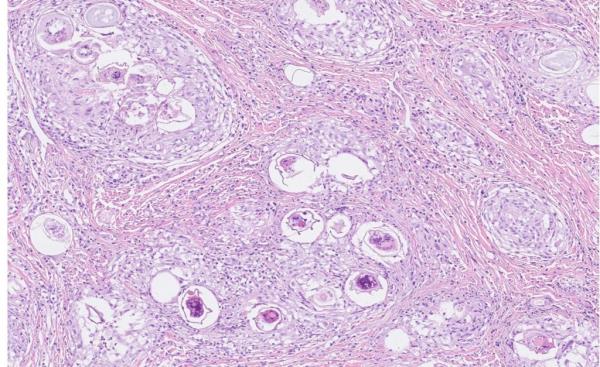 Numerous trematode ova surrounded by granulomatous inflammation and fibrous co<em></em>nnective tissue in the deep muscular layers of a dog.