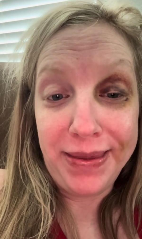 Woman sporting the black eye.
