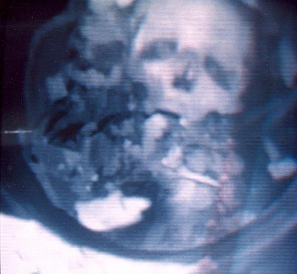 Formerly unidentified skull and bo<em></em>nes that were recovered by Madison, Wis., police in a chimney at the back of a former music store in the city in 1989. 