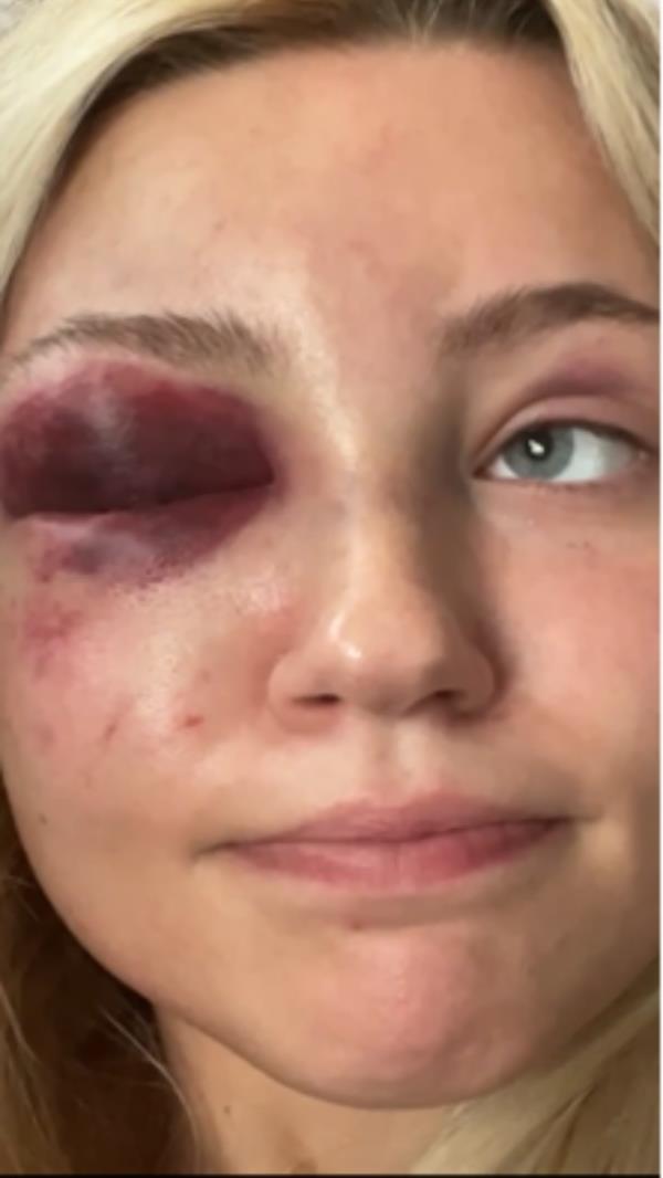 The surgeon allegedly tried to cover up a black eye by injecting filler without anesthetic.