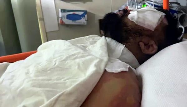 The clerk will need several surgeries as a result of his burns he suffered at the hands of Burton's attack.