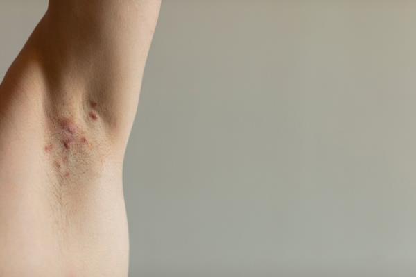 Hidradenitis suppurativa is a lesion-causing inflammatory disorder that affects at least 1 in 100 people and is stro<em></em>ngly associated with obesity.