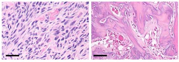 L pane - histopathology of untreated osteosarcoma, R panel - formation of mature bone in osteosarcoma in which the Hh signalling pathway has been inhibited